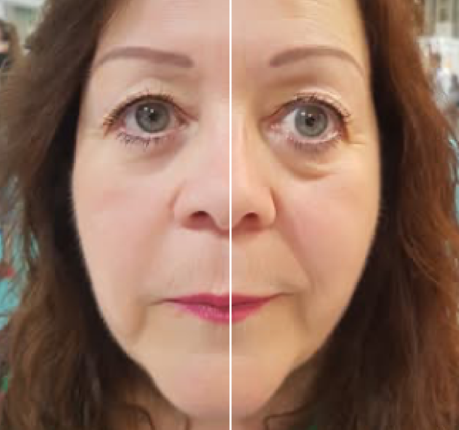 Before/After Results using Eyesential under eye enhancer